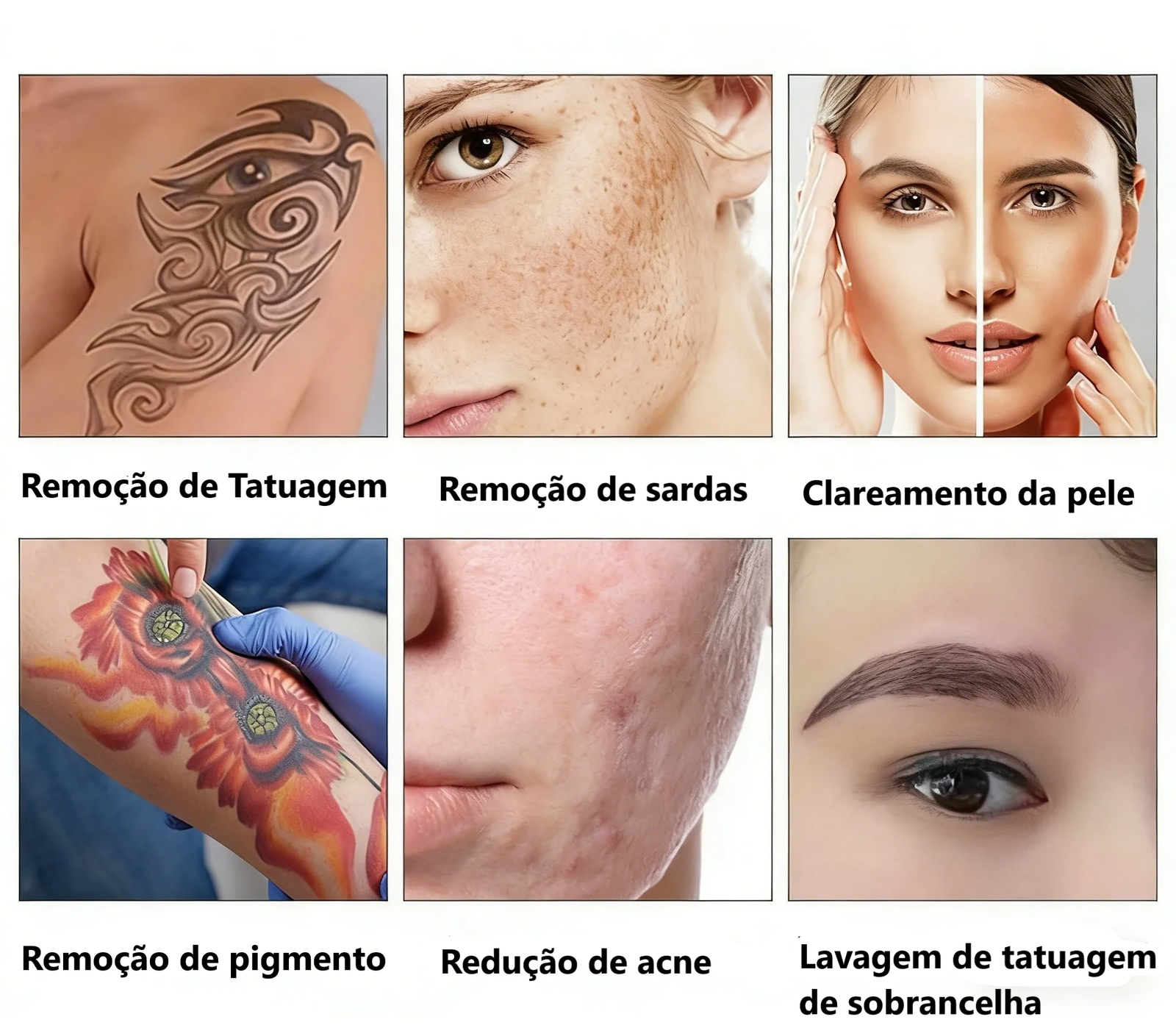Maquina laser remover tatuagem depilação comprar