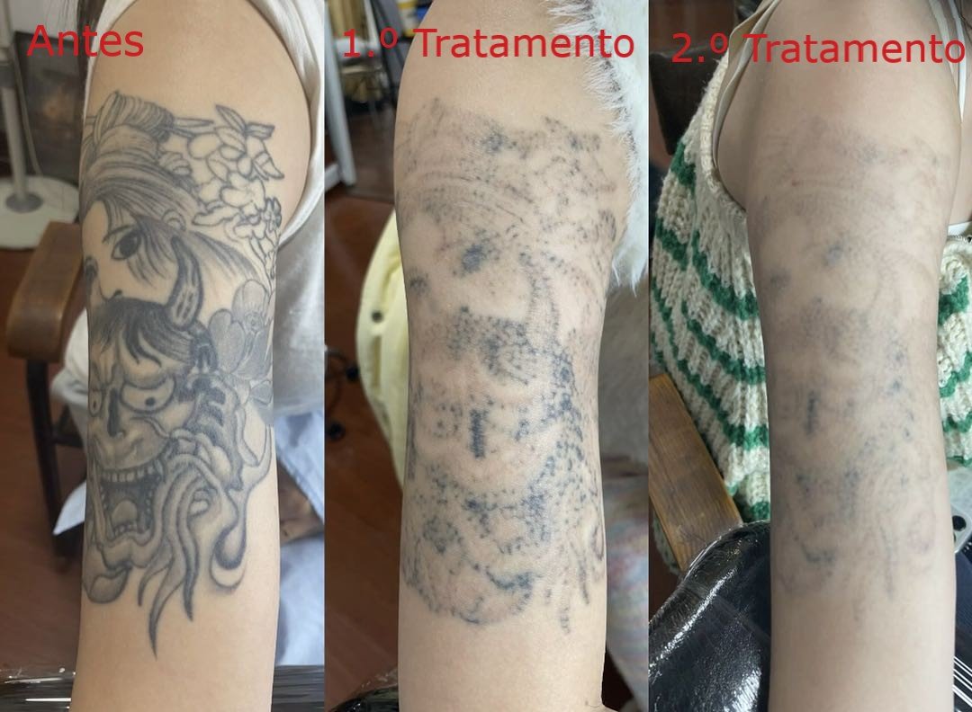 Maquina laser remover tatuagem comprar